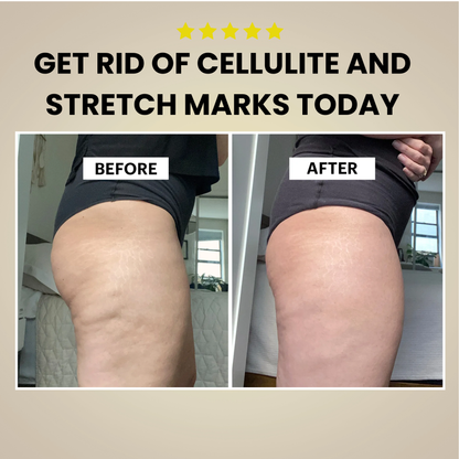 Cellulite Remover